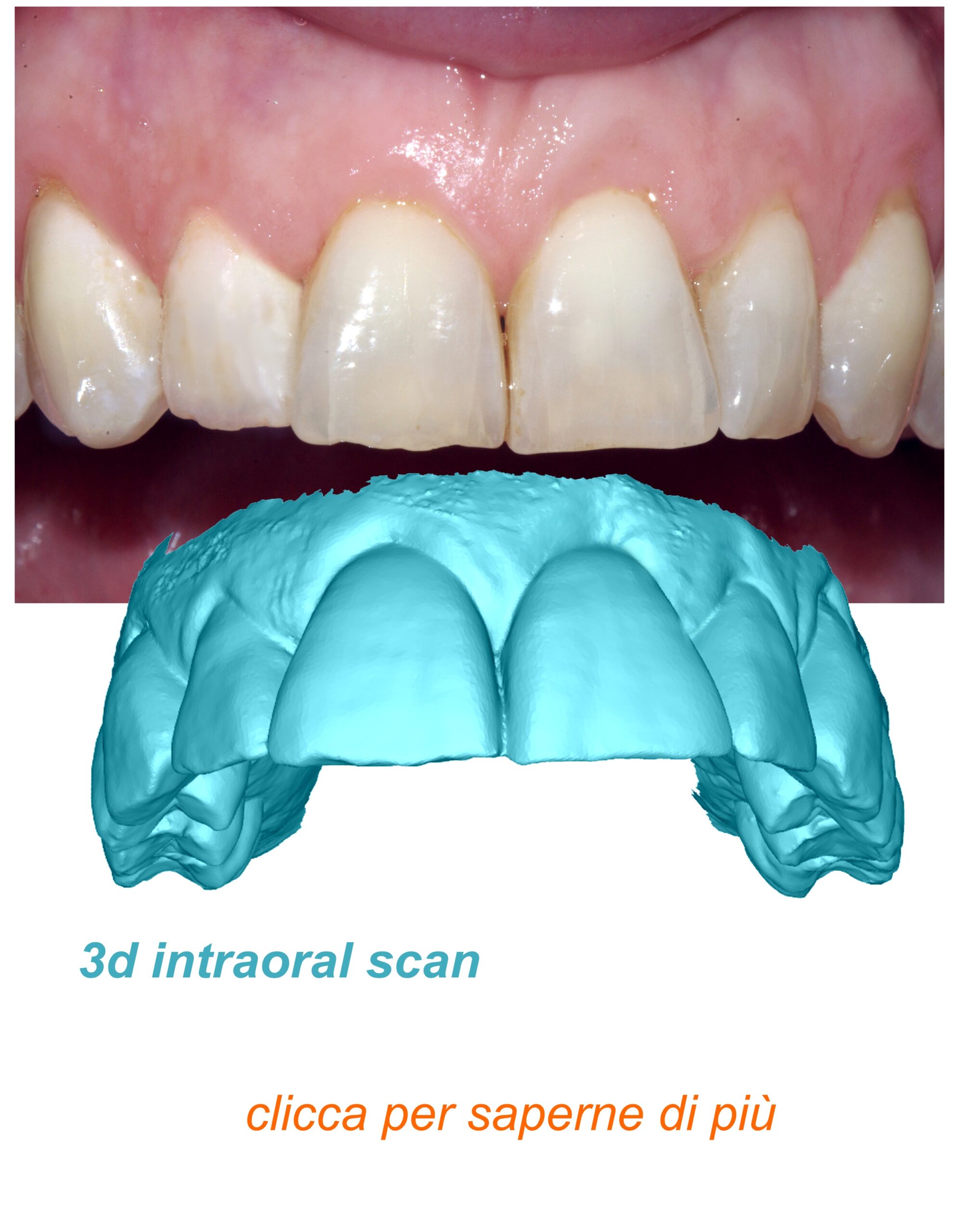 intraoral scan